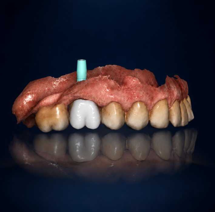 Implant Crown – Digital Design