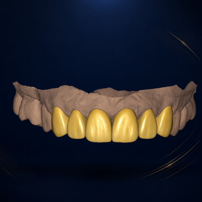 Veneer – Digital Design